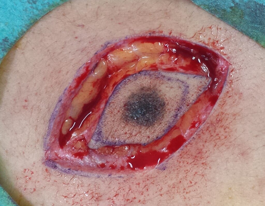 Desarrollan una herramienta que mejora la extracción de tumores malignos en la piel