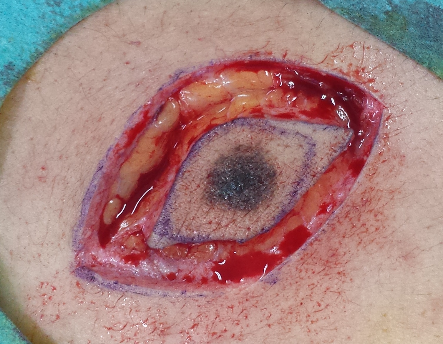 Desarrollan una herramienta que mejora la extracción de tumores malignos en la piel